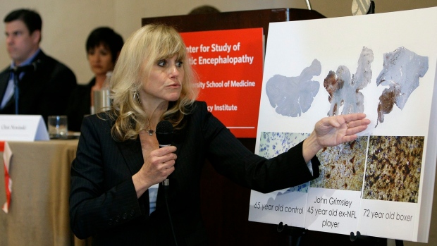 CTE Concussion Brain science, The Canadian Press CTE Concussion Brain science