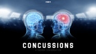 Concussions